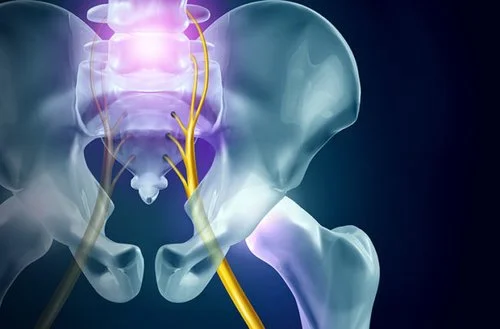 How Pilates Helps with Sciatic Nerve Pain